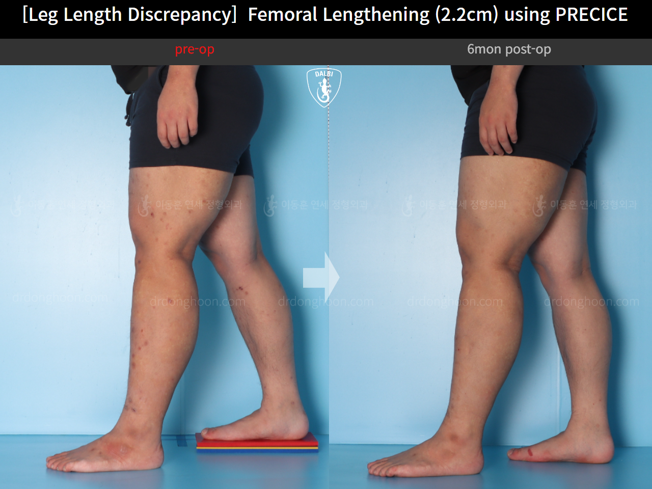 Before and after adult lld, case 15416698, image 8, Dr. Donghoon institute (DALRI)