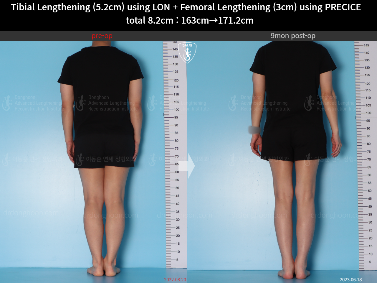Before and after cll precice, case 15203330, image 4, Dr. Donghoon institute (DALRI)