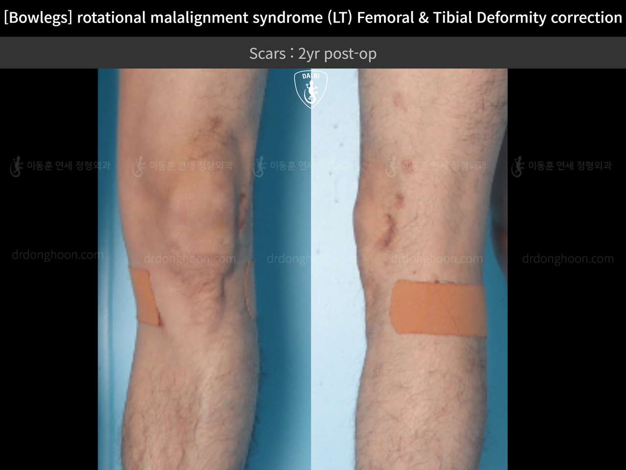 Before and after adult bowlegs, case 13266718, image 9, Dr. Donghoon institute (DALRI)