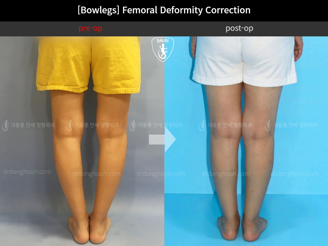 Before and after adult bowlegs, case 11379035, image 5, Dr. Donghoon institute (DALRI)