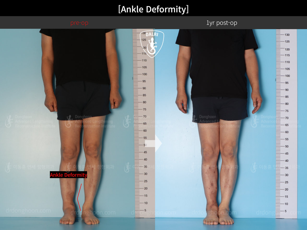 Before and after foot & ankle deformity, case 13580612, image 3, Dr. Donghoon institute (DALRI)