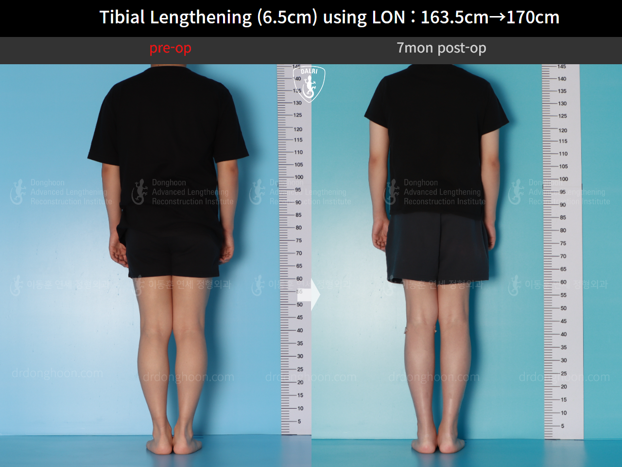Before and after cll lon, case 17199046, image 2, Dr. Donghoon institute (DALRI)