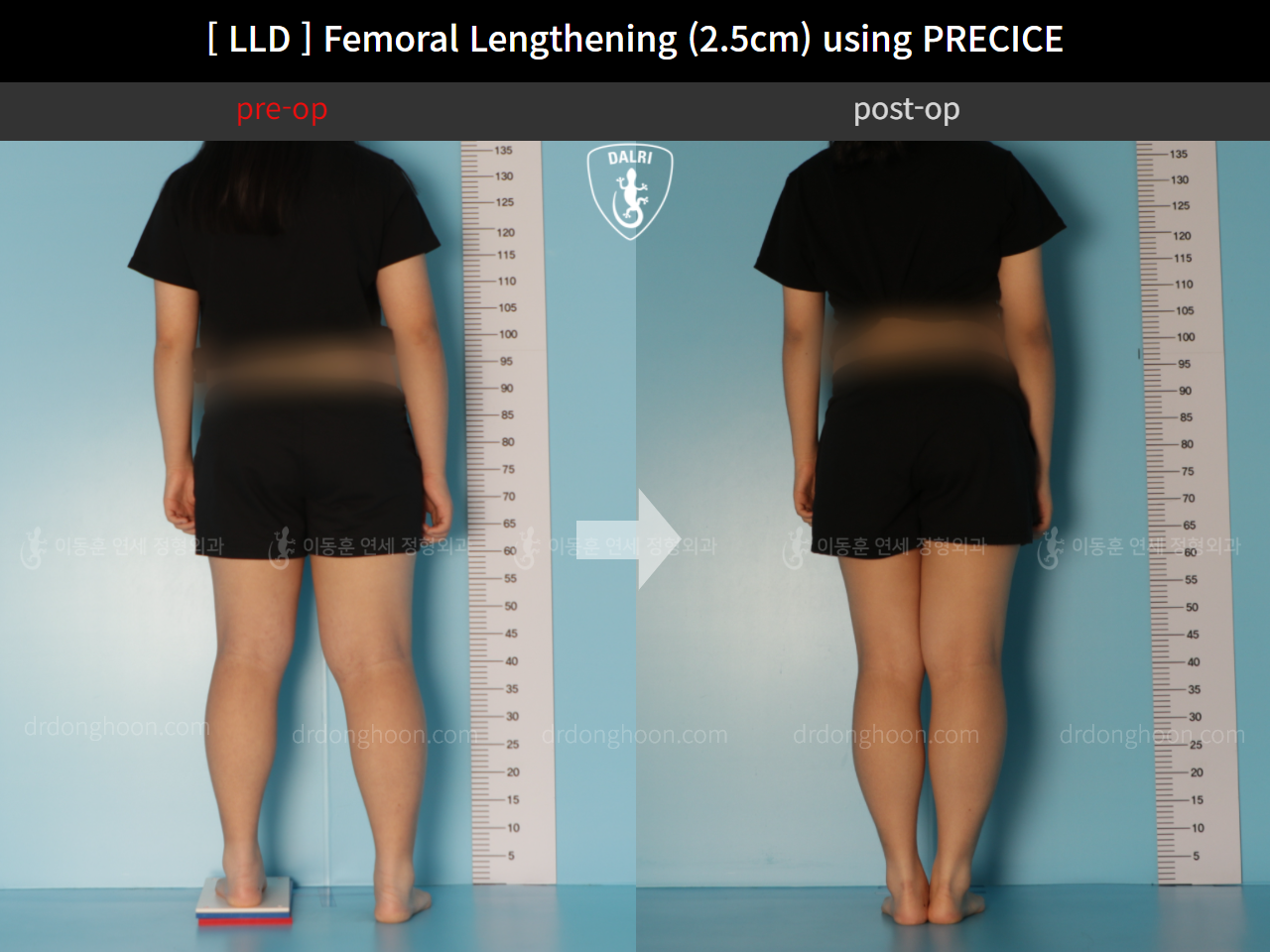 Before and after adult lld, case 11367647, image 2, Dr. Donghoon institute (DALRI)