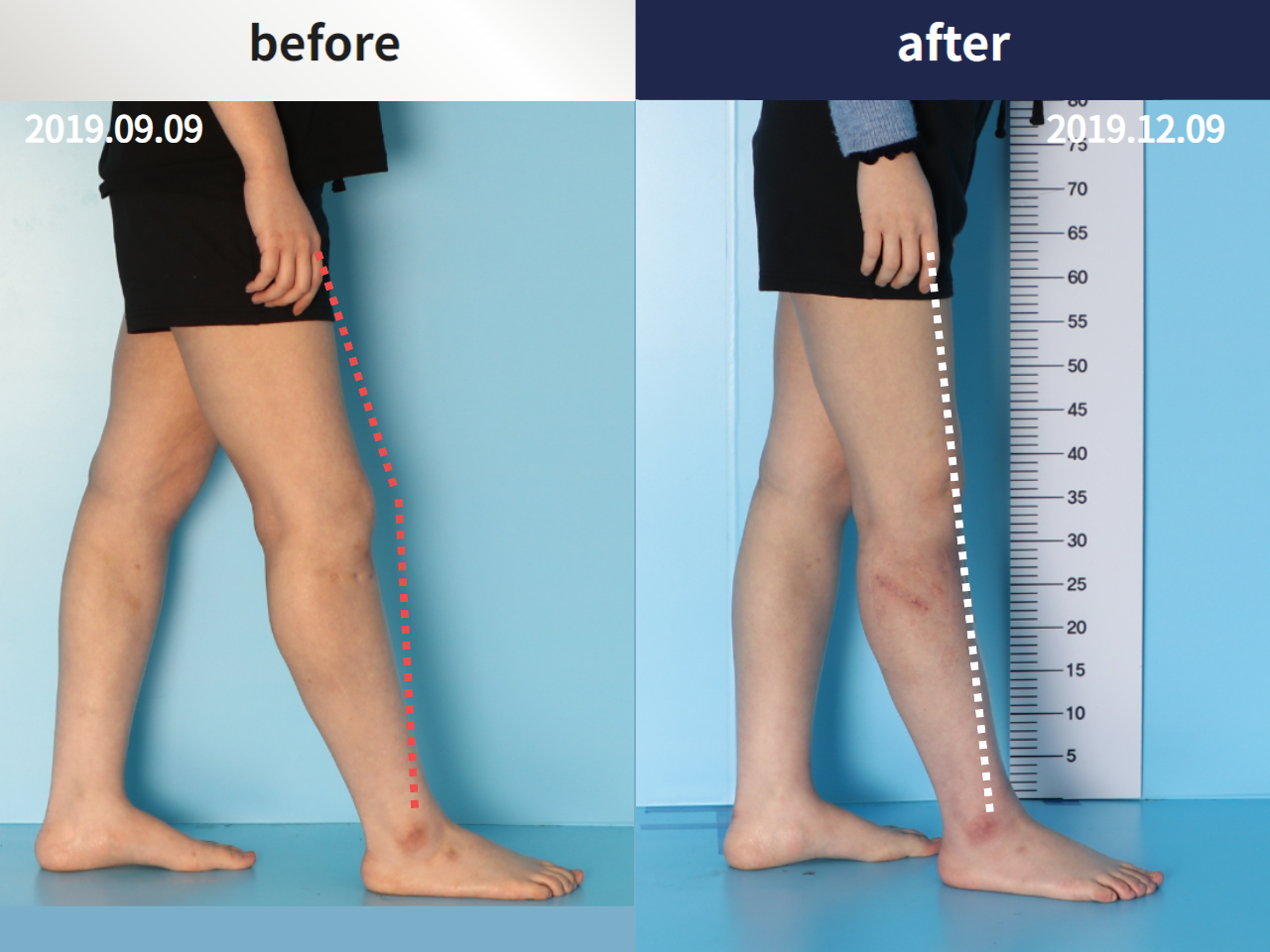 Before and after complex deformity, case 4297342, image 3, Dr. Donghoon institute (DALRI)