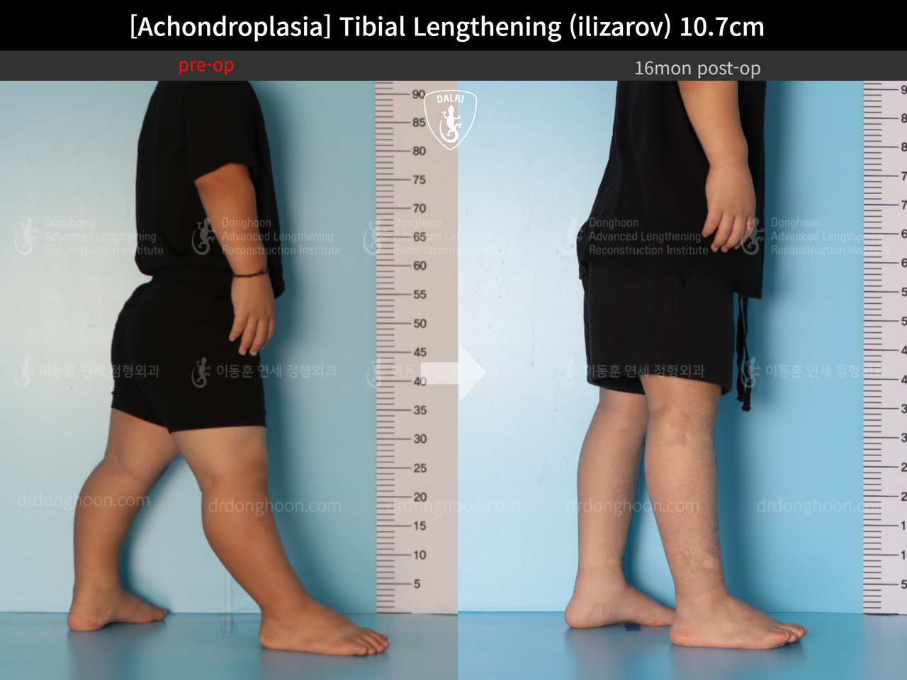 Before and after paediatric congenital condition, case 13489647, image 9, Dr. Donghoon institute (DALRI)