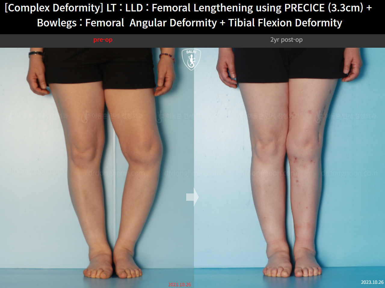 Before and after complex deformity, case 16786707, image 11, Dr. Donghoon institute (DALRI)
