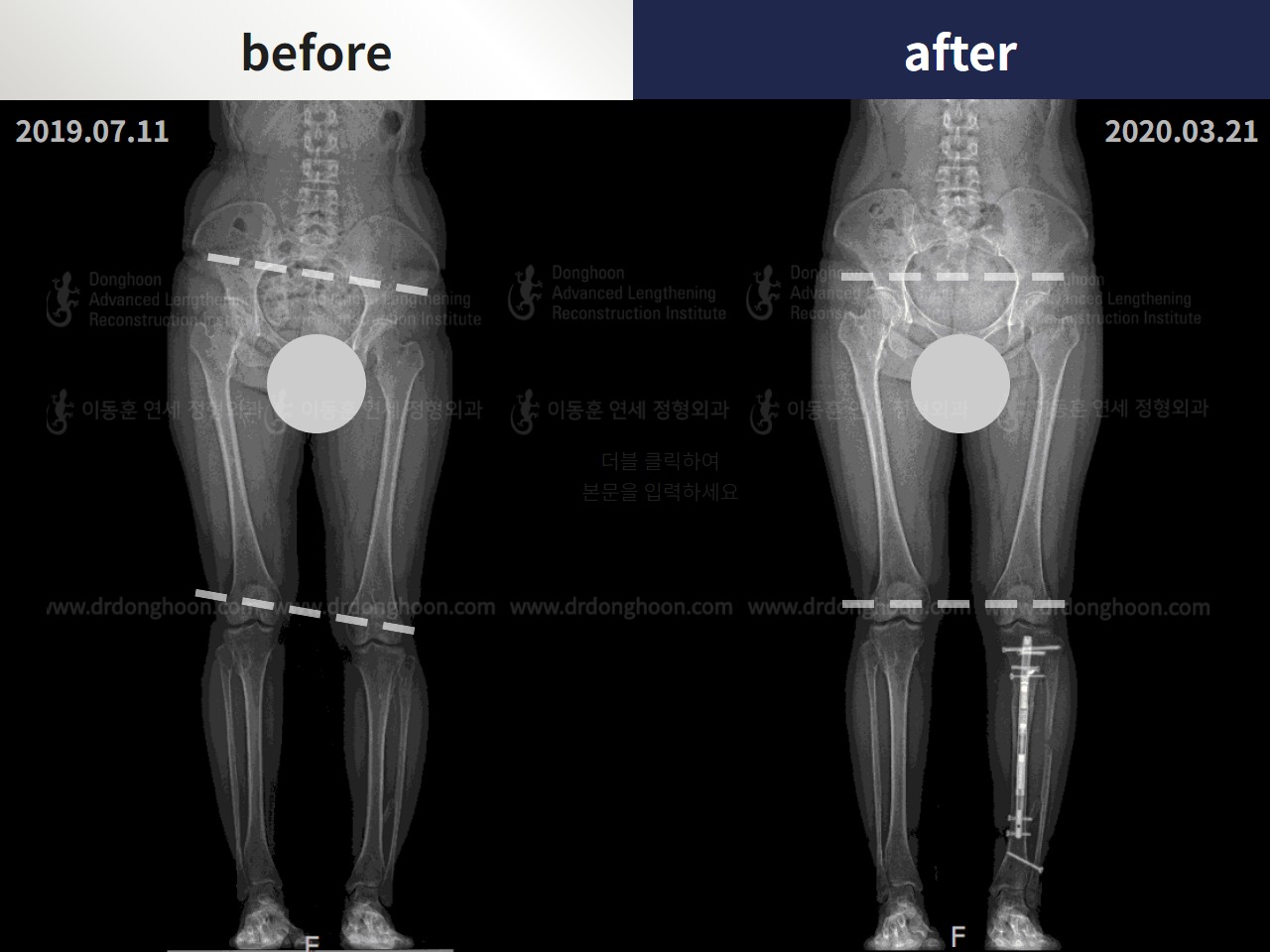 Before and after adult lld, case 4320362, image 3, Dr. Donghoon institute (DALRI)