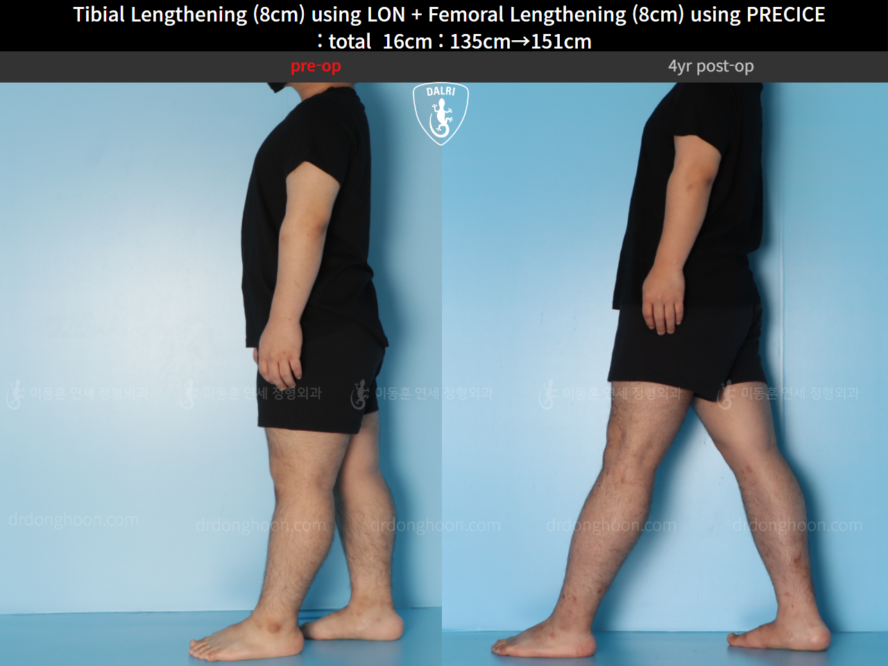 Before and after cll precice, case 128435842, image 4, Dr. Donghoon institute (DALRI)
