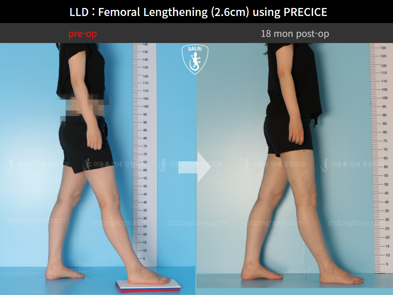 Before and after adult lld, case 9332755, image 3, Dr. Donghoon institute (DALRI)