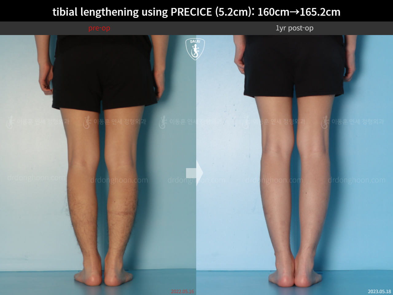 Before and after cll precice, case 15213098, image 10, Dr. Donghoon institute (DALRI)