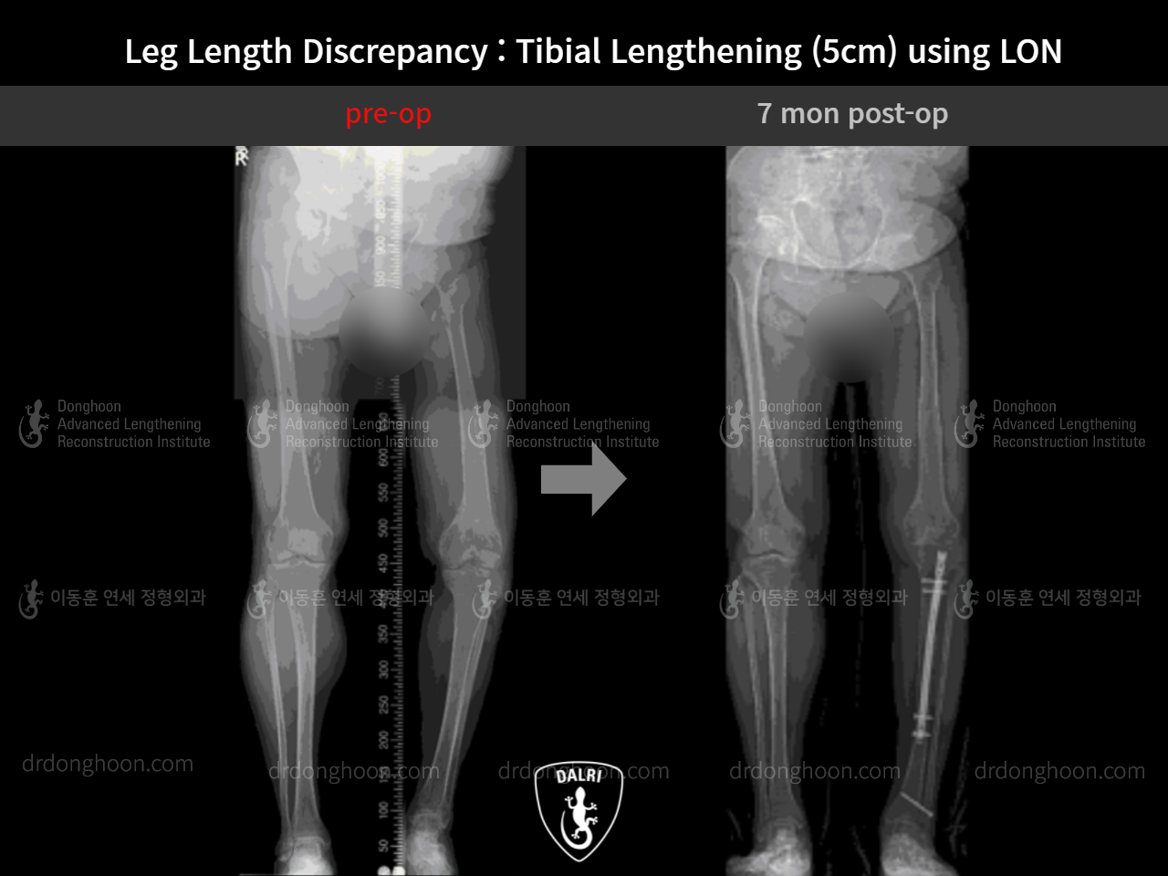 Before and after adult lld, case 9165807, image 9, Dr. Donghoon institute (DALRI)