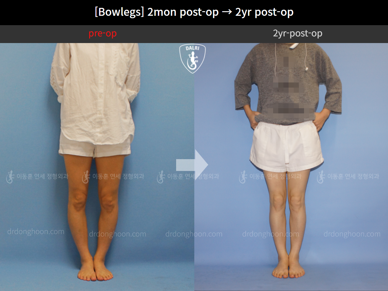 Before and after adult bowlegs, case 4311373, image 3, Dr. Donghoon institute (DALRI)