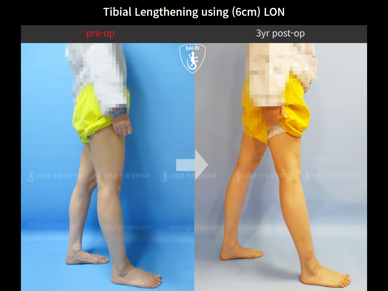 Before and after cll lon, case 4323981, image 3, Dr. Donghoon institute (DALRI)