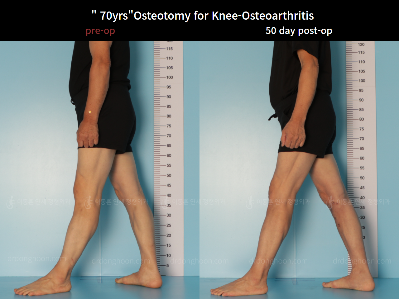 Before and after osteotomy for knee osteoarthritis, case 7753851, image 5, Dr. Donghoon institute (DALRI)