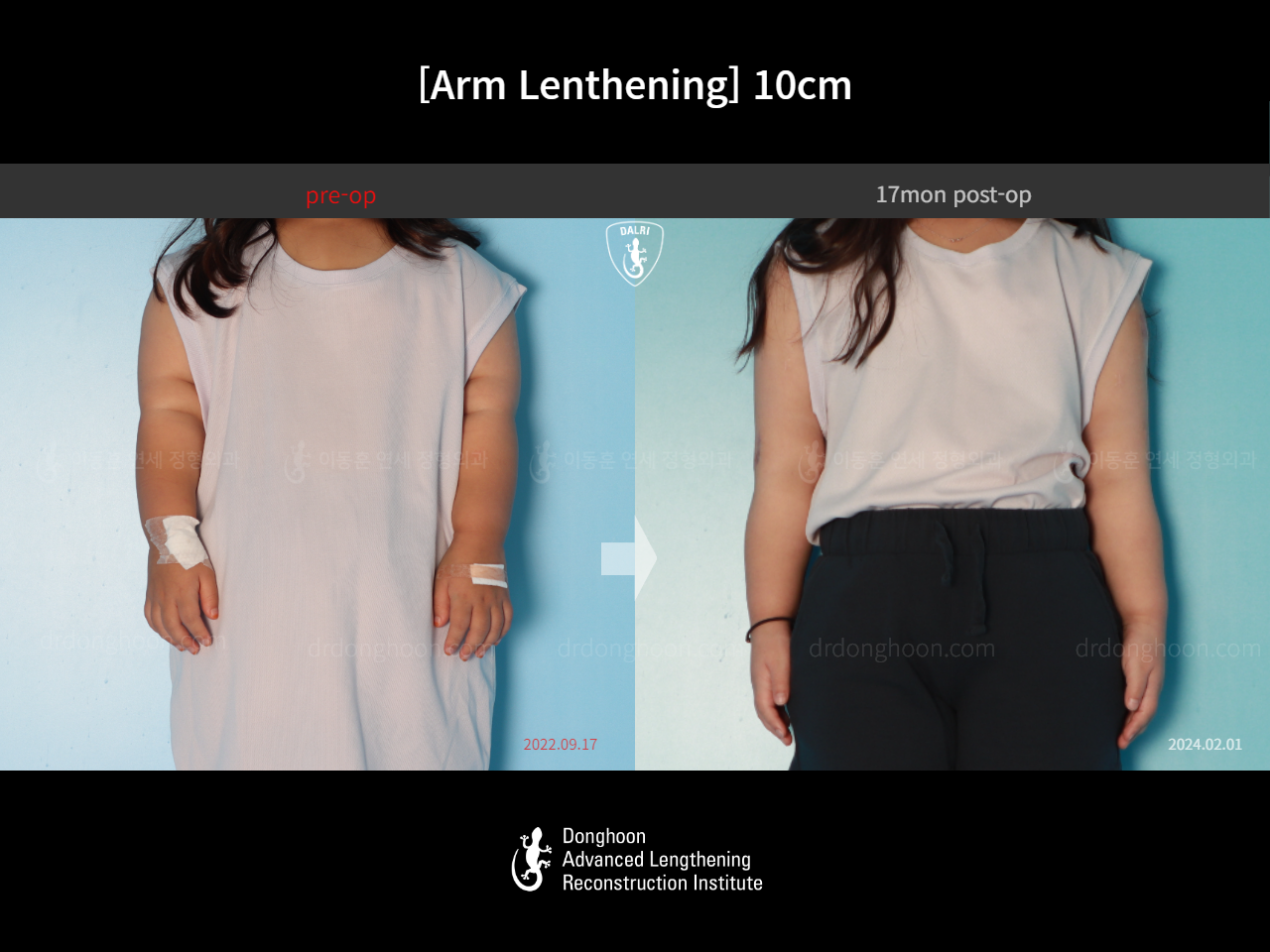 Before and after arm lengthening, case 17924395, image 1, Dr. Donghoon institute (DALRI)