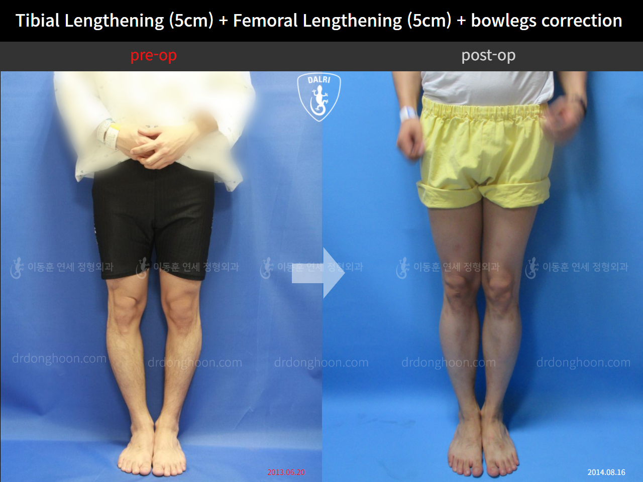 Before and after cll + deformity correction, case 4323174, image 1, Dr. Donghoon institute (DALRI)