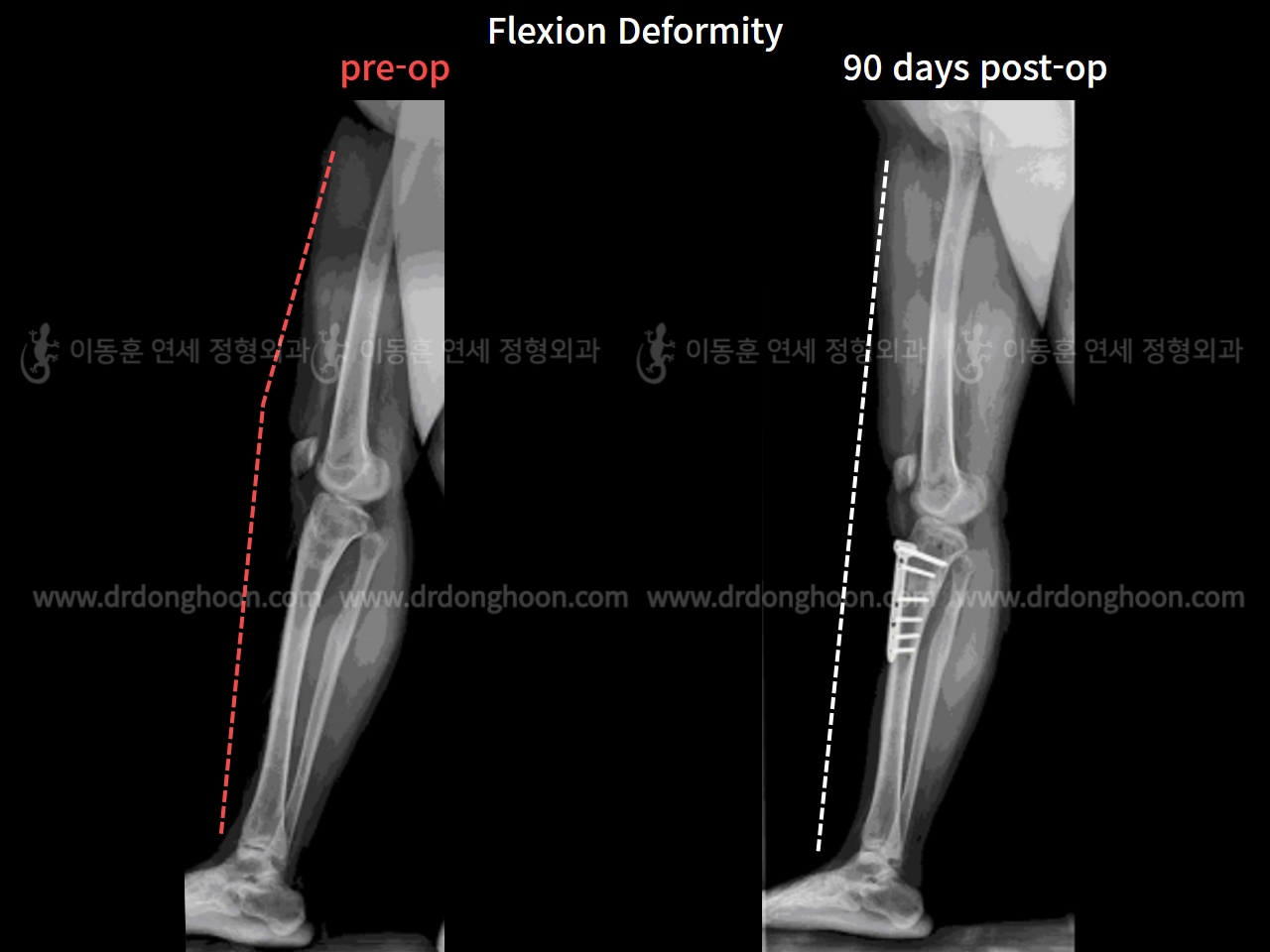 Before and after flexion deformity, case 7337190, image 1, Dr. Donghoon institute (DALRI)