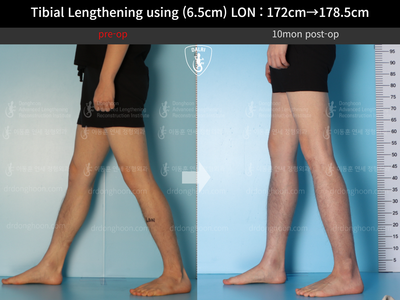 Before and after cll lon, case 13642628, image 6, Dr. Donghoon institute (DALRI)