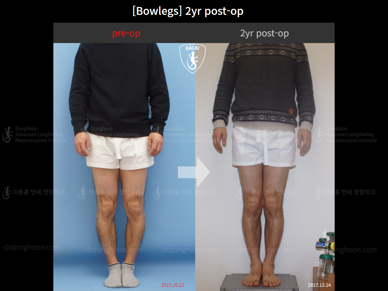 Before and after adult bowlegs, case 4311027, image 1, Dr. Donghoon institute (DALRI)