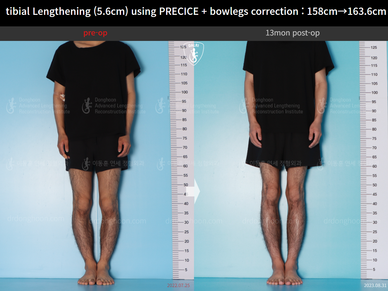 Before and after cll precice, case 16213622, image 1, Dr. Donghoon institute (DALRI)