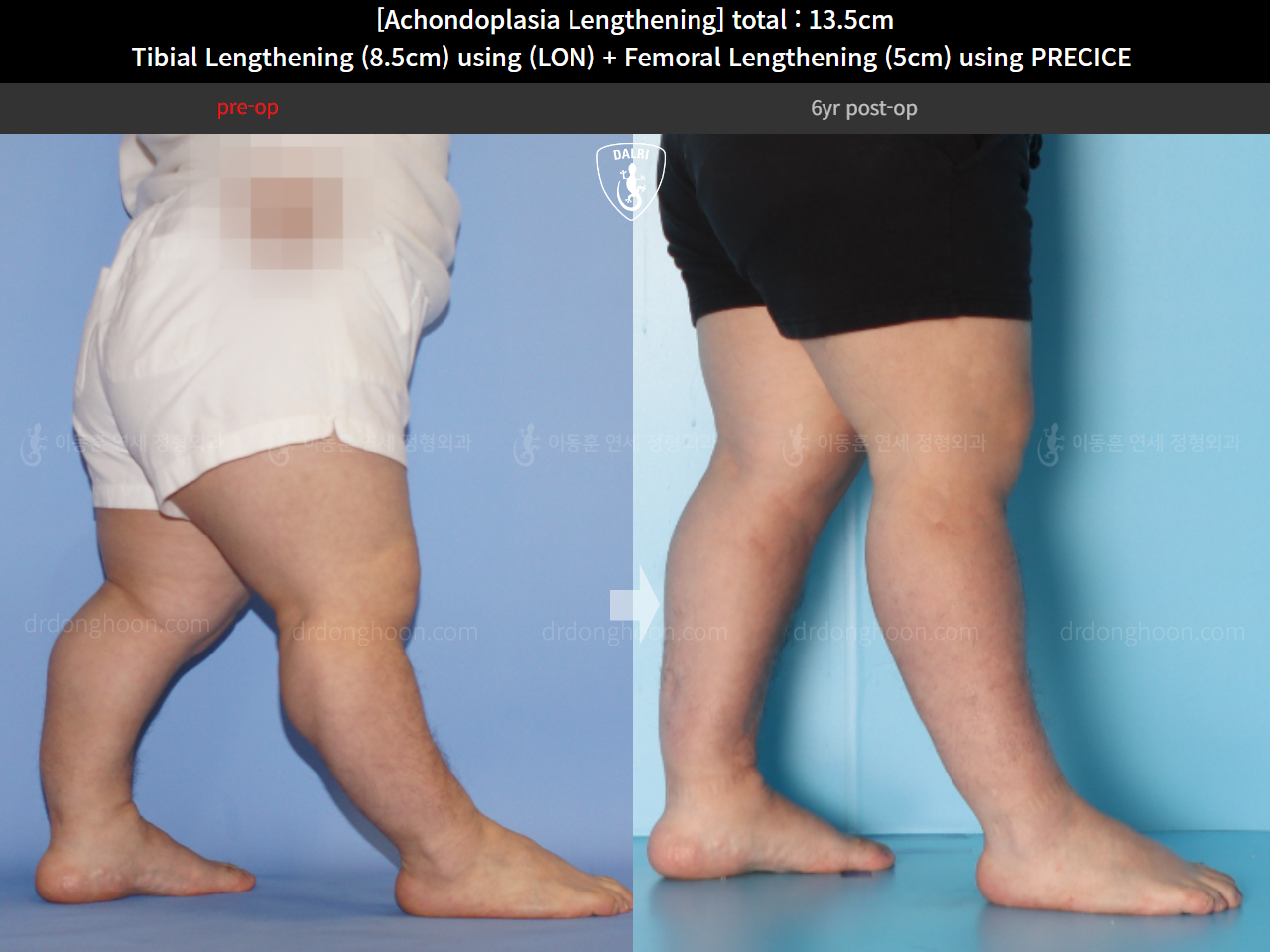 Before and after cll lon, case 14993527, image 12, Dr. Donghoon institute (DALRI)