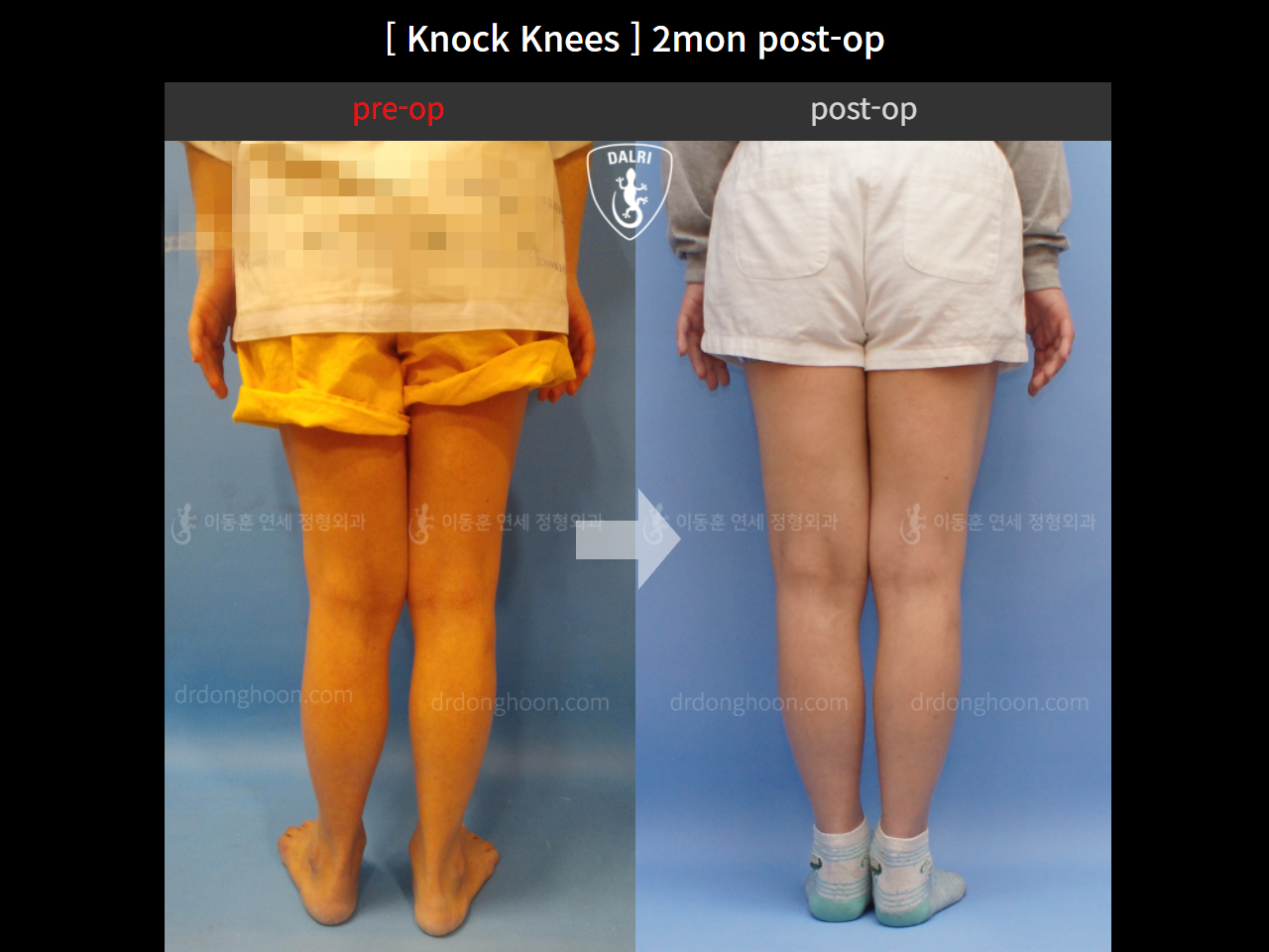 Before and after adult knock knees, case 4640593, image 2, Dr. Donghoon institute (DALRI)