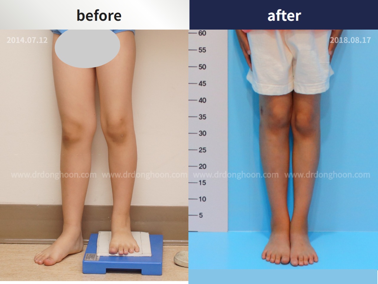 Before and after paediatric & adolescent lld, case 4320426, image 3, Dr. Donghoon institute (DALRI)