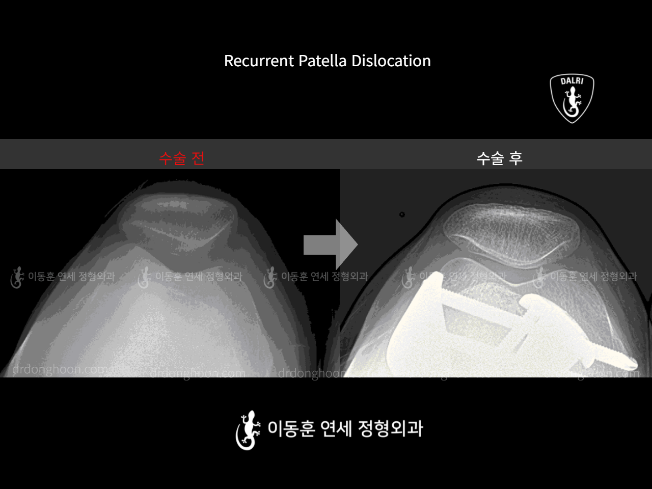 Before and after recurrent patella dislocation, case 10475088, image 6, Dr. Donghoon institute (DALRI)