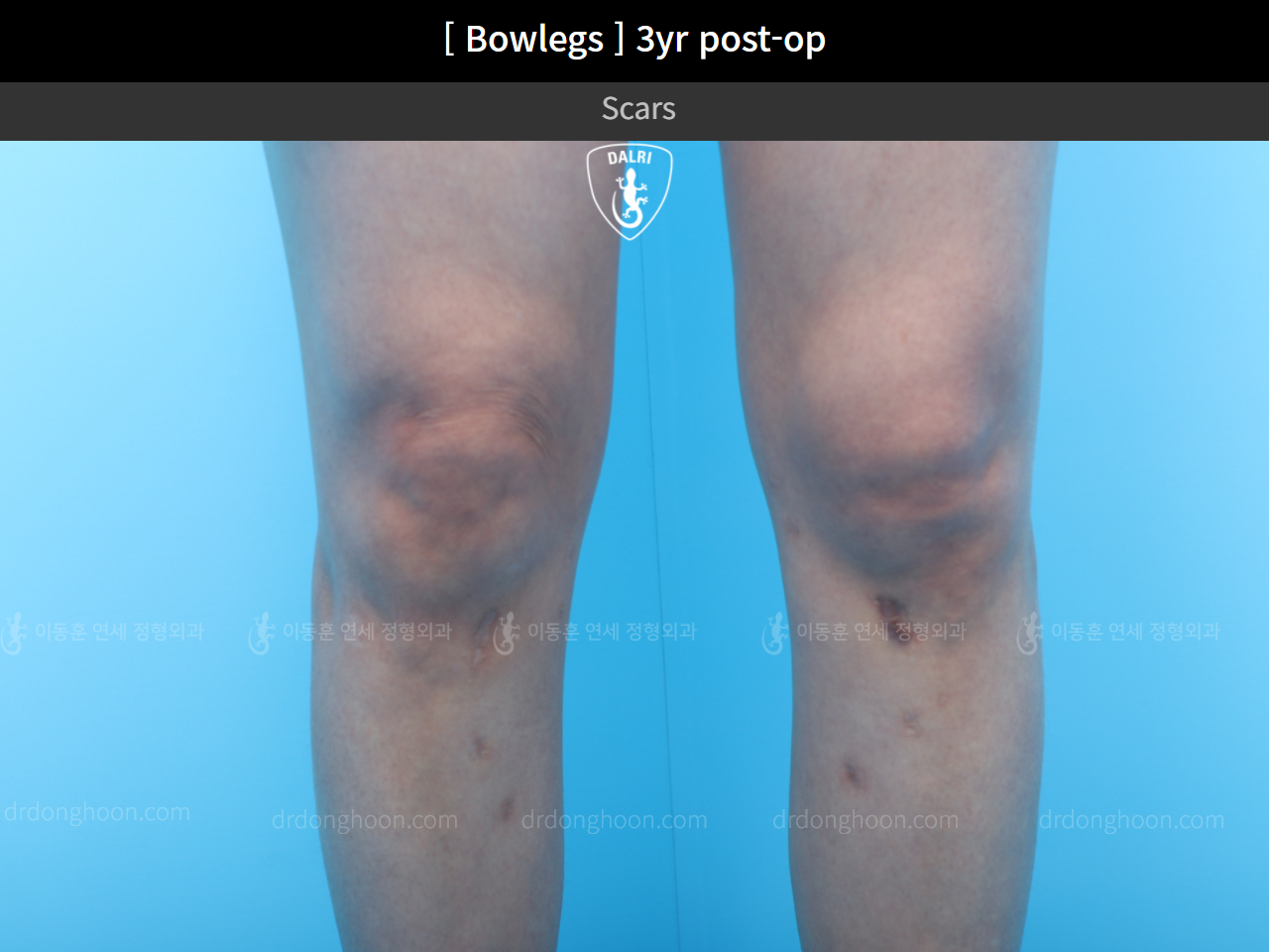 Before and after adult bowlegs, case 4311006, image 3, Dr. Donghoon institute (DALRI)