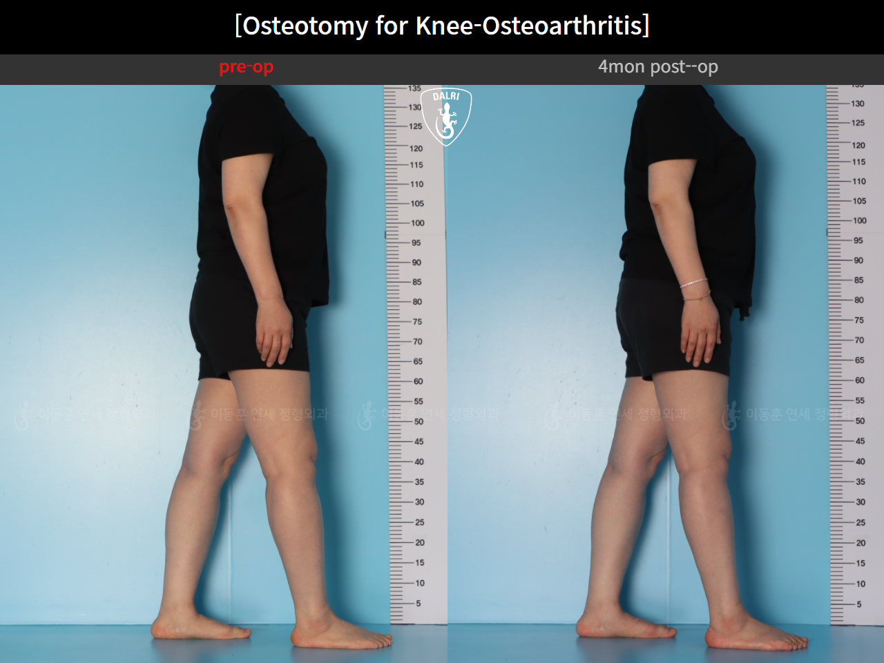 Before and after osteotomy for knee osteoarthritis, case 39778471, image 6, Dr. Donghoon institute (DALRI)