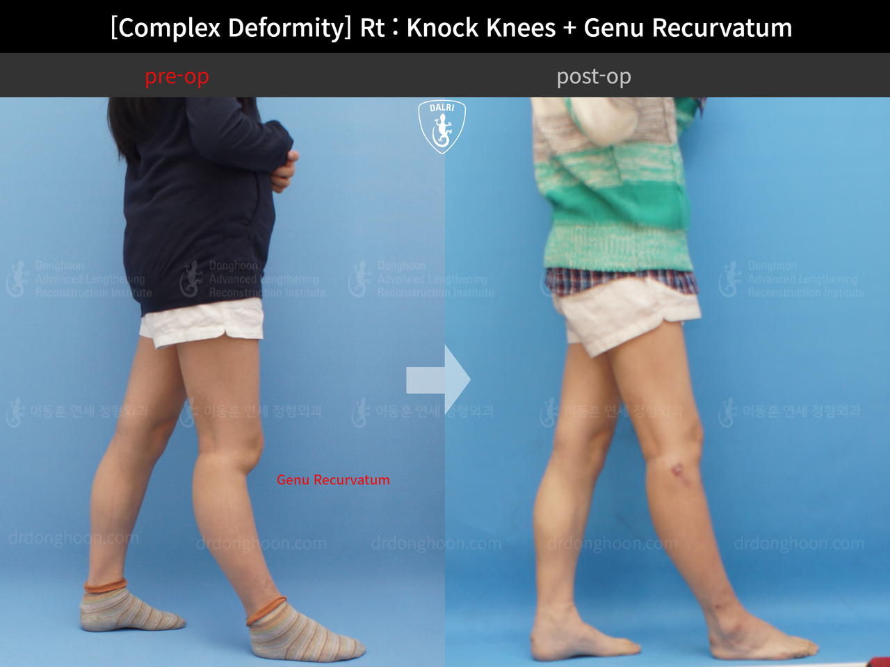 Before and after complex deformity, case 13204696, image 3, Dr. Donghoon institute (DALRI)
