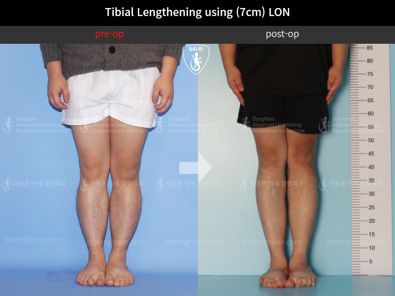 Before and after cll lon, case 10452499, image 4, Dr. Donghoon institute (DALRI)