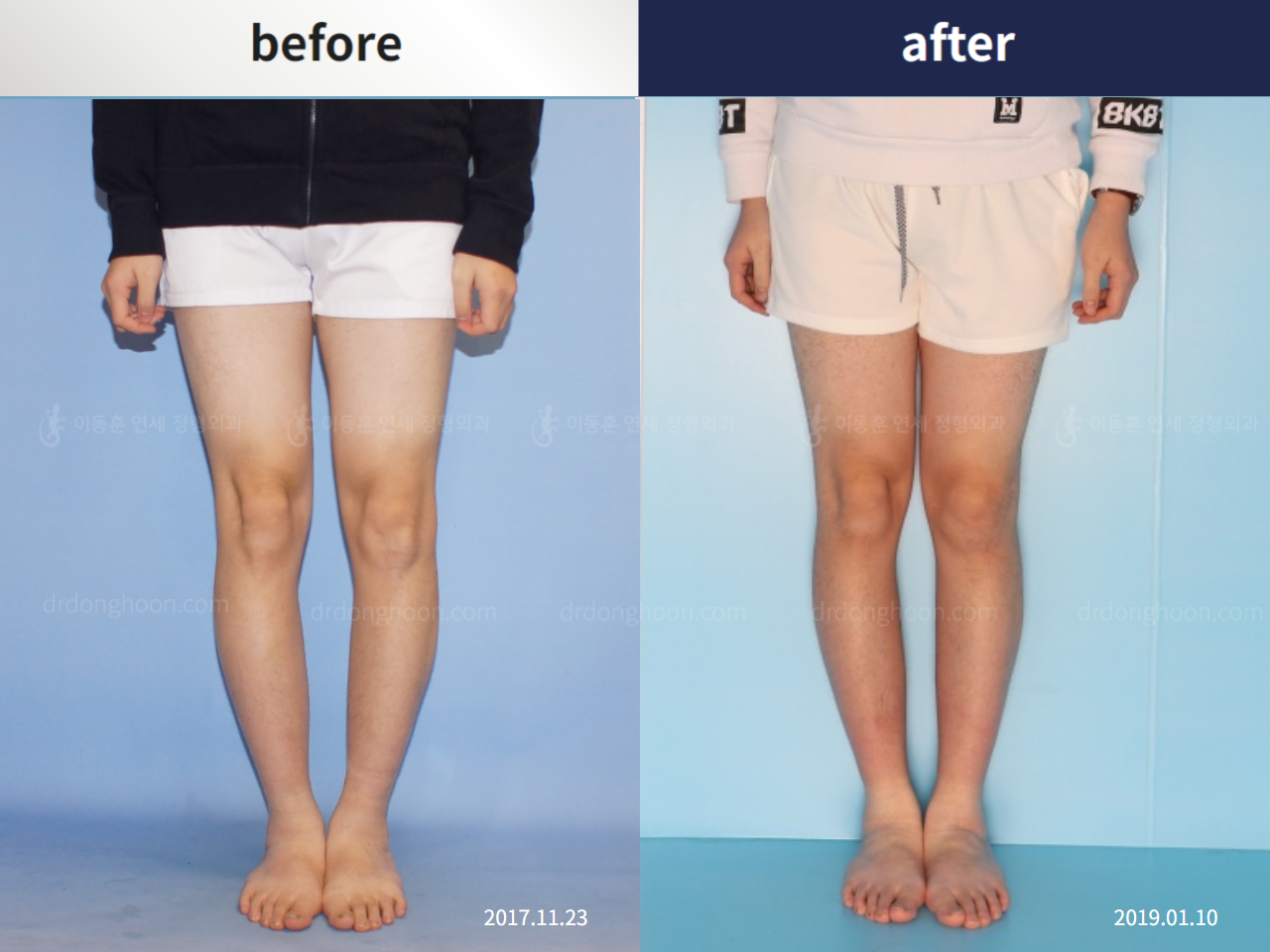 Before and after paediatric & adolescent bowlegs, case 4320255, image 1, Dr. Donghoon institute (DALRI)