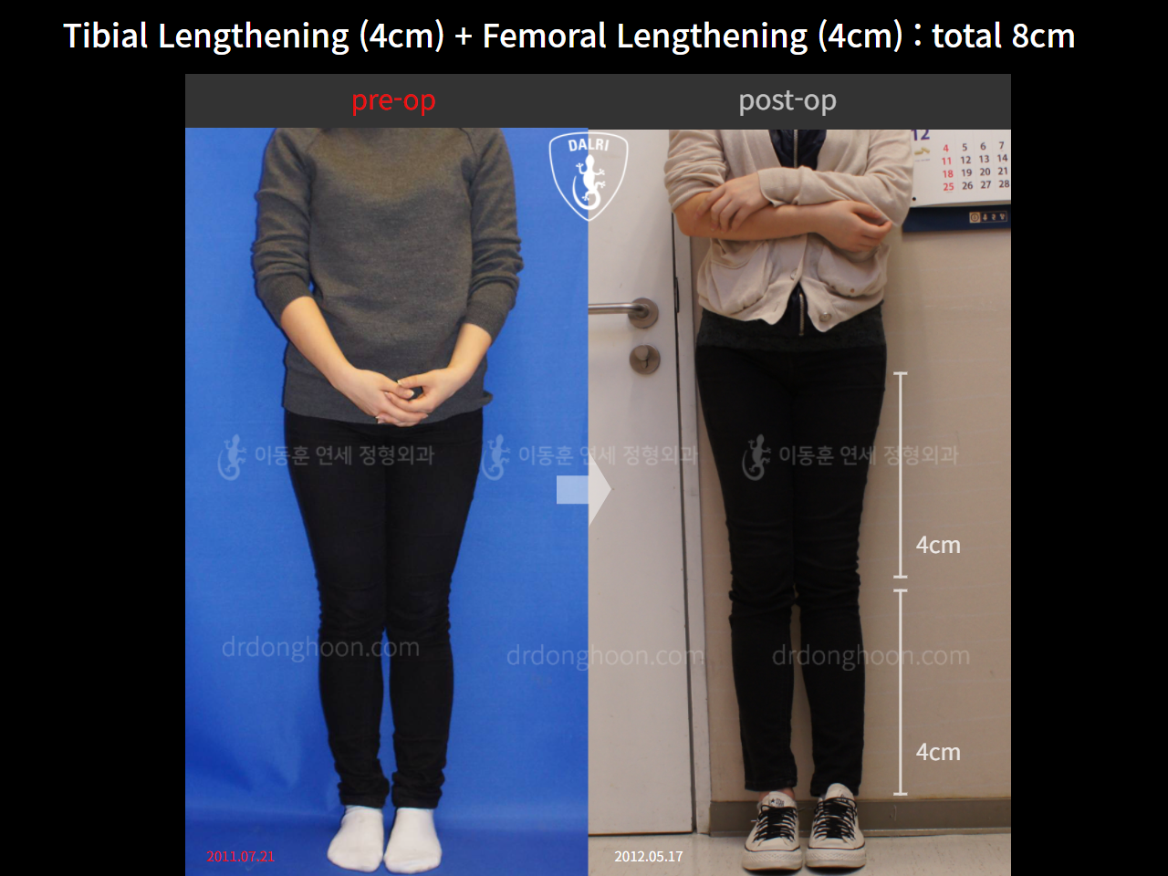 Before and after cll lon, case 11035120, image 1, Dr. Donghoon institute (DALRI)