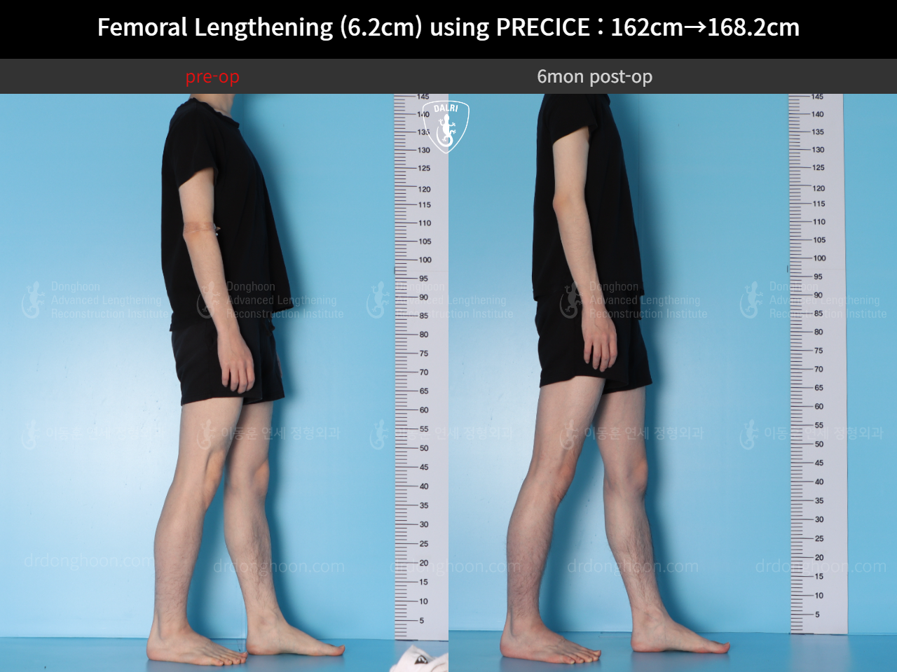 Before and after cll precice, case 15393865, image 6, Dr. Donghoon institute (DALRI)