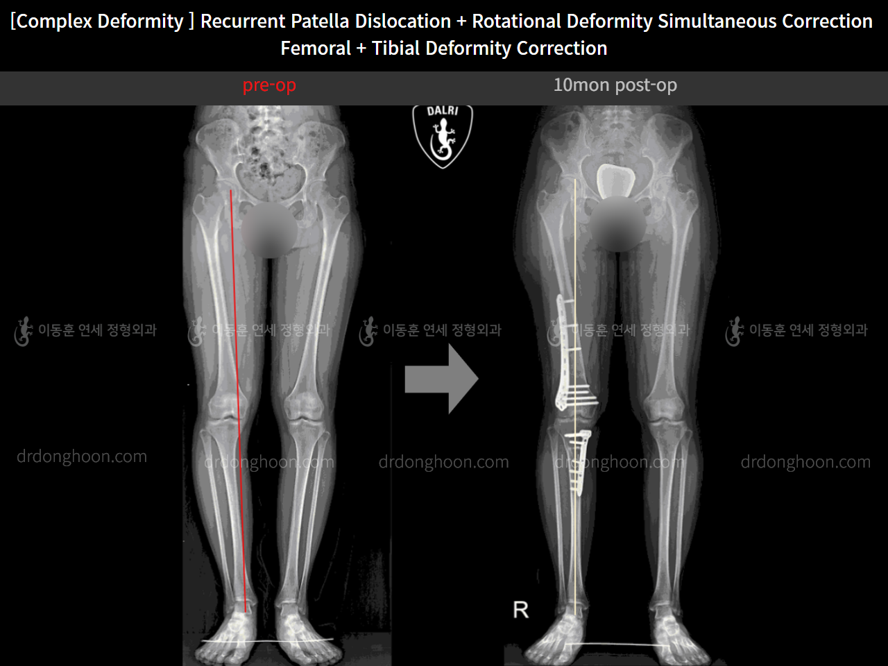 Before and after recurrent patella dislocation, case 10475088, image 5, Dr. Donghoon institute (DALRI)