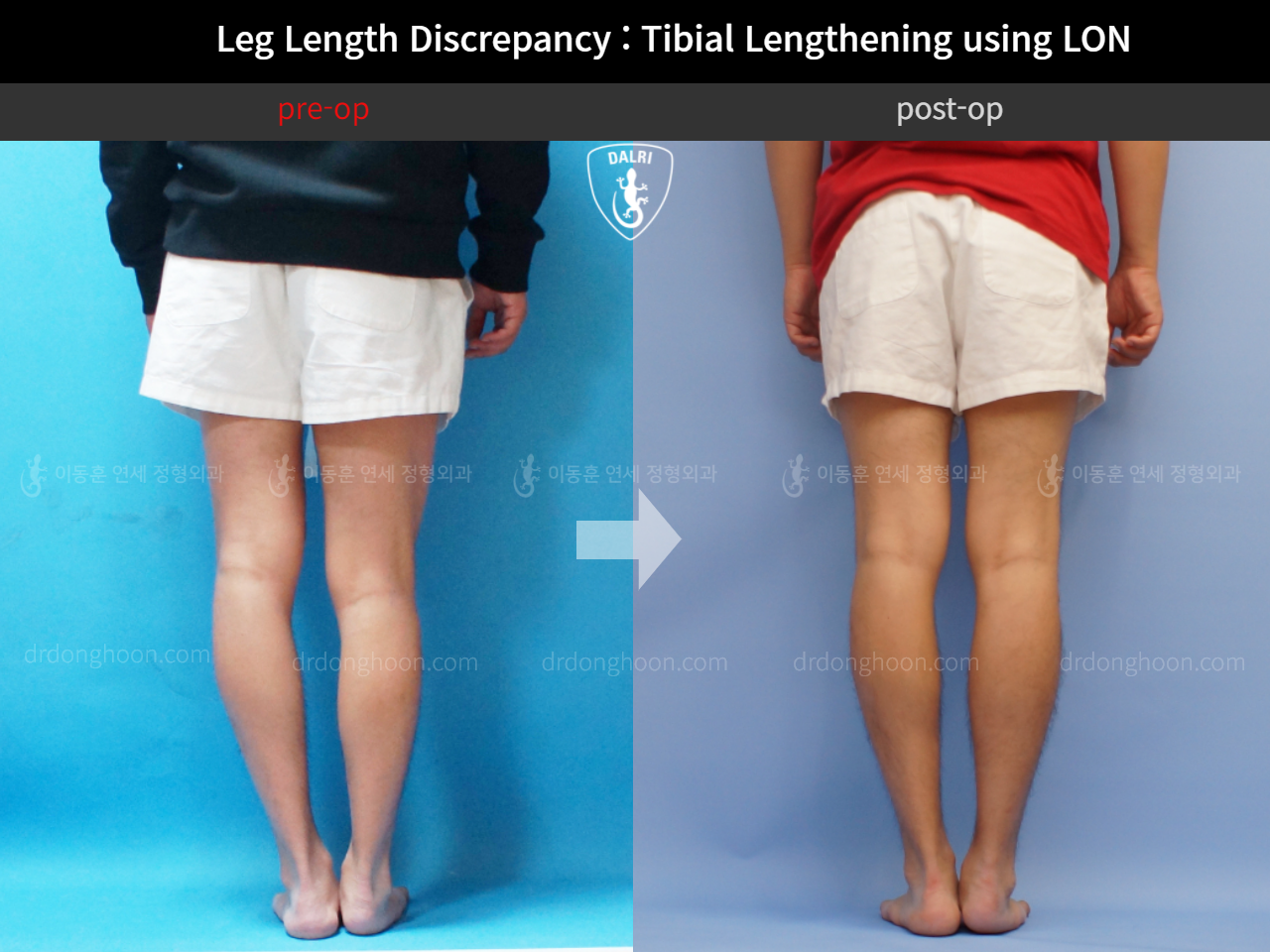 Before and after adult lld, case 11651115, image 4, Dr. Donghoon institute (DALRI)