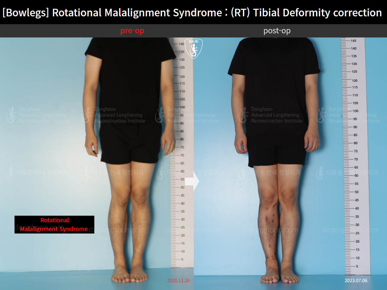 Before and after adult bowlegs, case 16482195, image 1, Dr. Donghoon institute (DALRI)