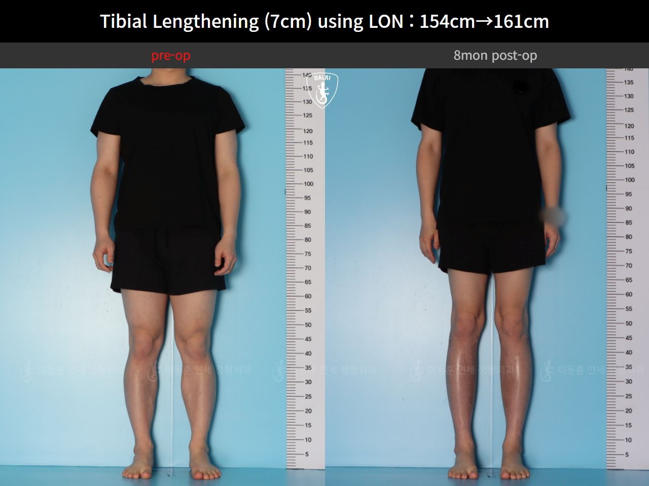 Before and after cll lon, case 127519935, image 2, Dr. Donghoon institute (DALRI)