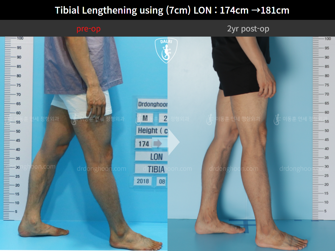 Before and after cll lon, case 5316185, image 7, Dr. Donghoon institute (DALRI)