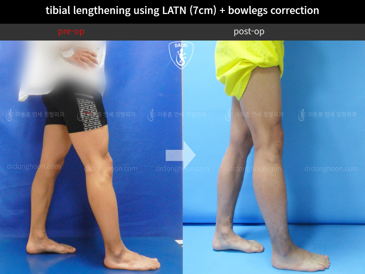 Before and after cll + deformity correction, case 4323114, image 6, Dr. Donghoon institute (DALRI)