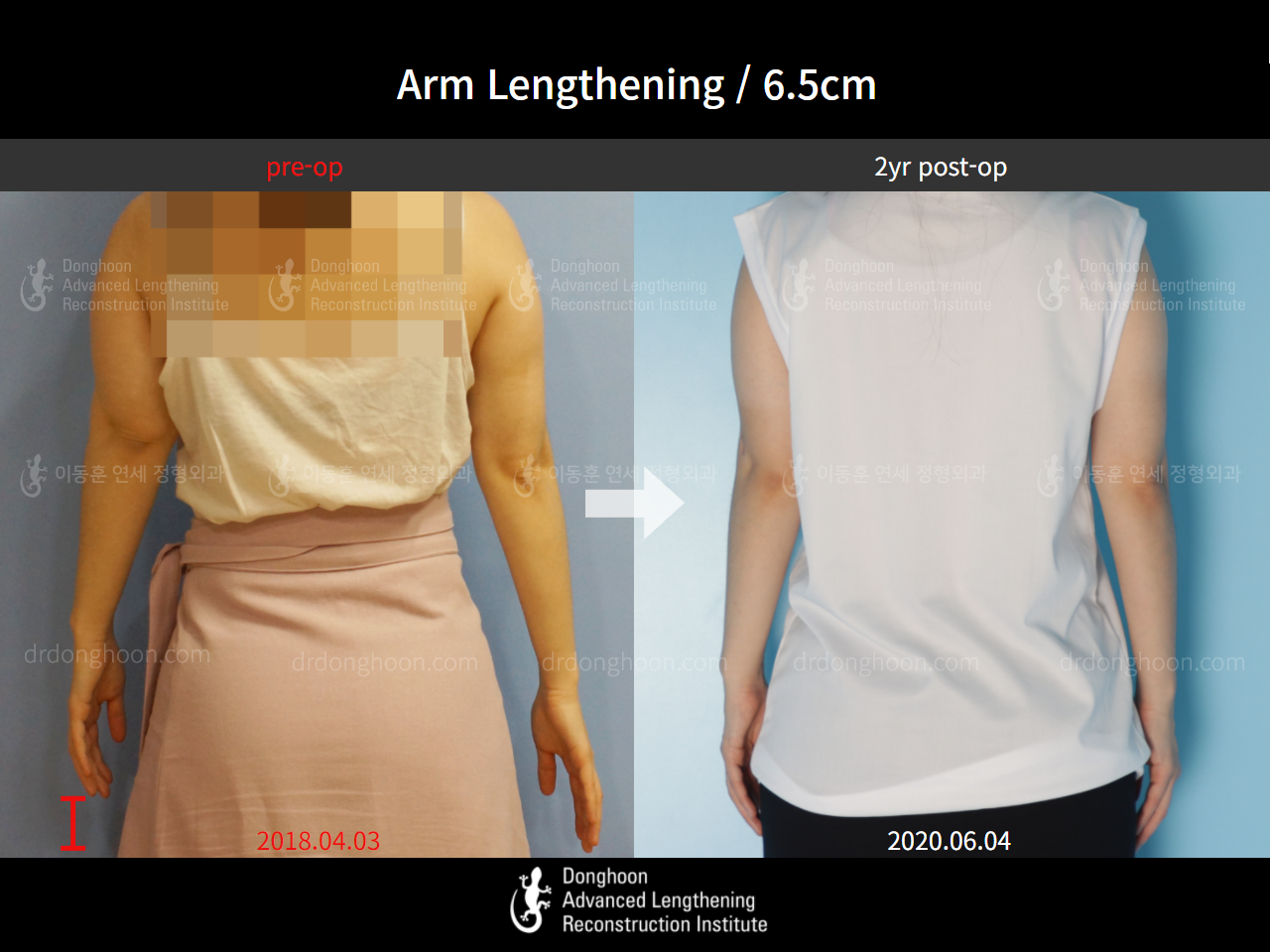 Before and after arm lengthening, case 4249373, image 2, Dr. Donghoon institute (DALRI)