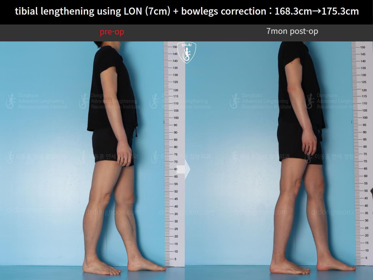 Before and after cll + deformity correction, case 21918246, image 6, Dr. Donghoon institute (DALRI)