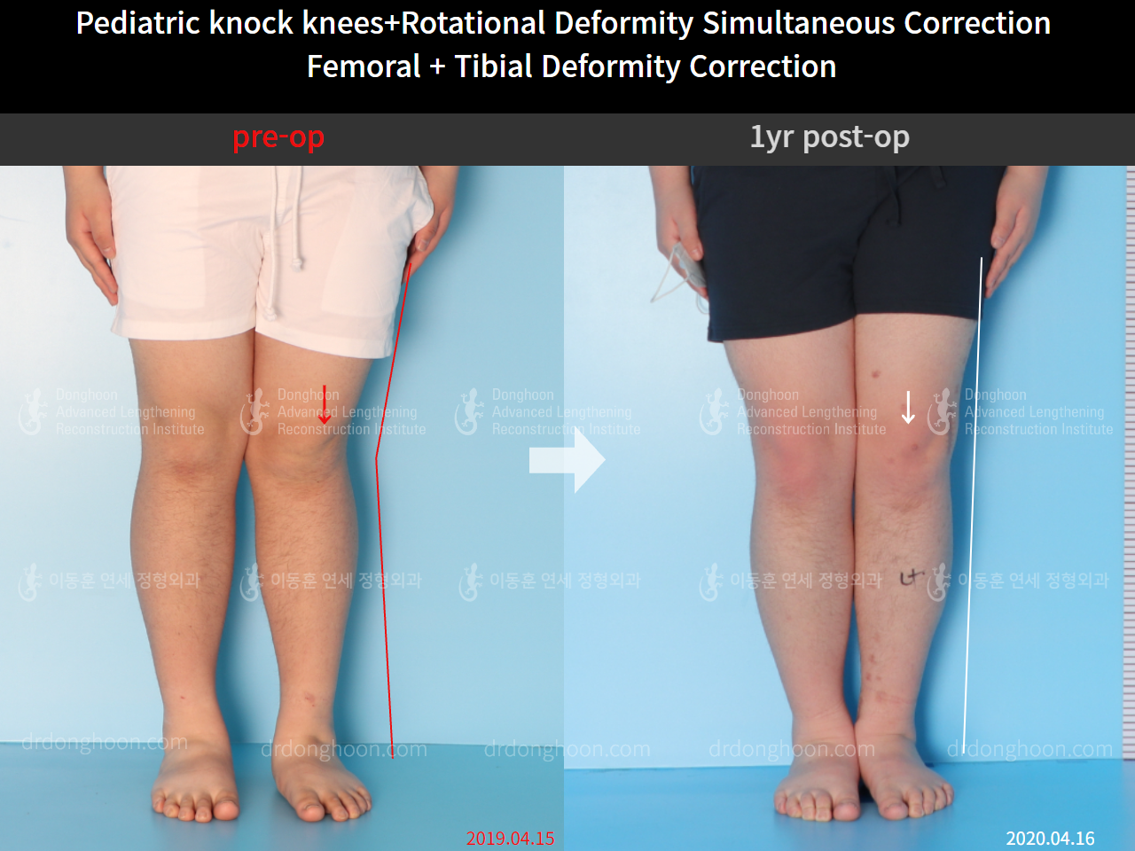 Before and after paediatric & adolescent knock knees, case 4640495, image 3, Dr. Donghoon institute (DALRI)