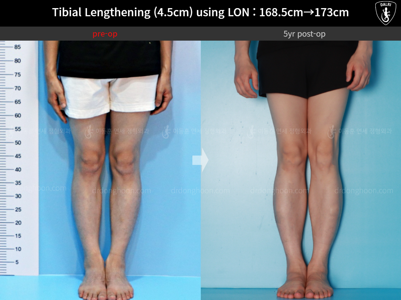 Before and after cll lon, case 16140967, image 7, Dr. Donghoon institute (DALRI)