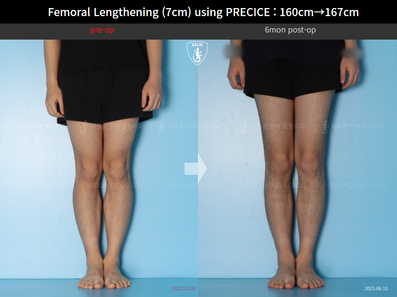 Before and after cll precice, case 15460533, image 9, Dr. Donghoon institute (DALRI)
