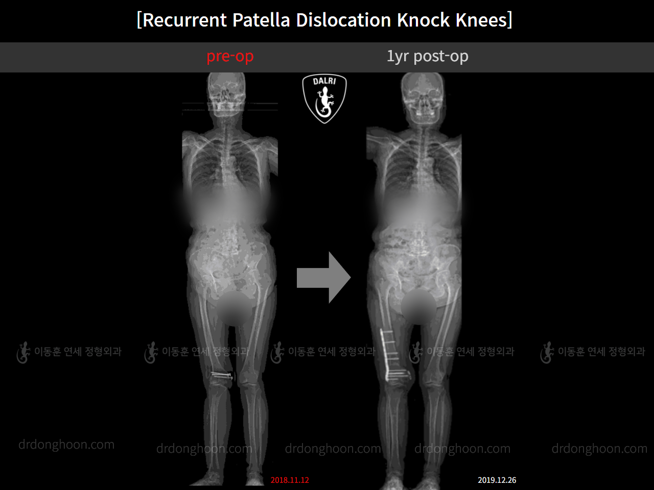 Before and after adult knock knees, case 11291745, image 1, Dr. Donghoon institute (DALRI)