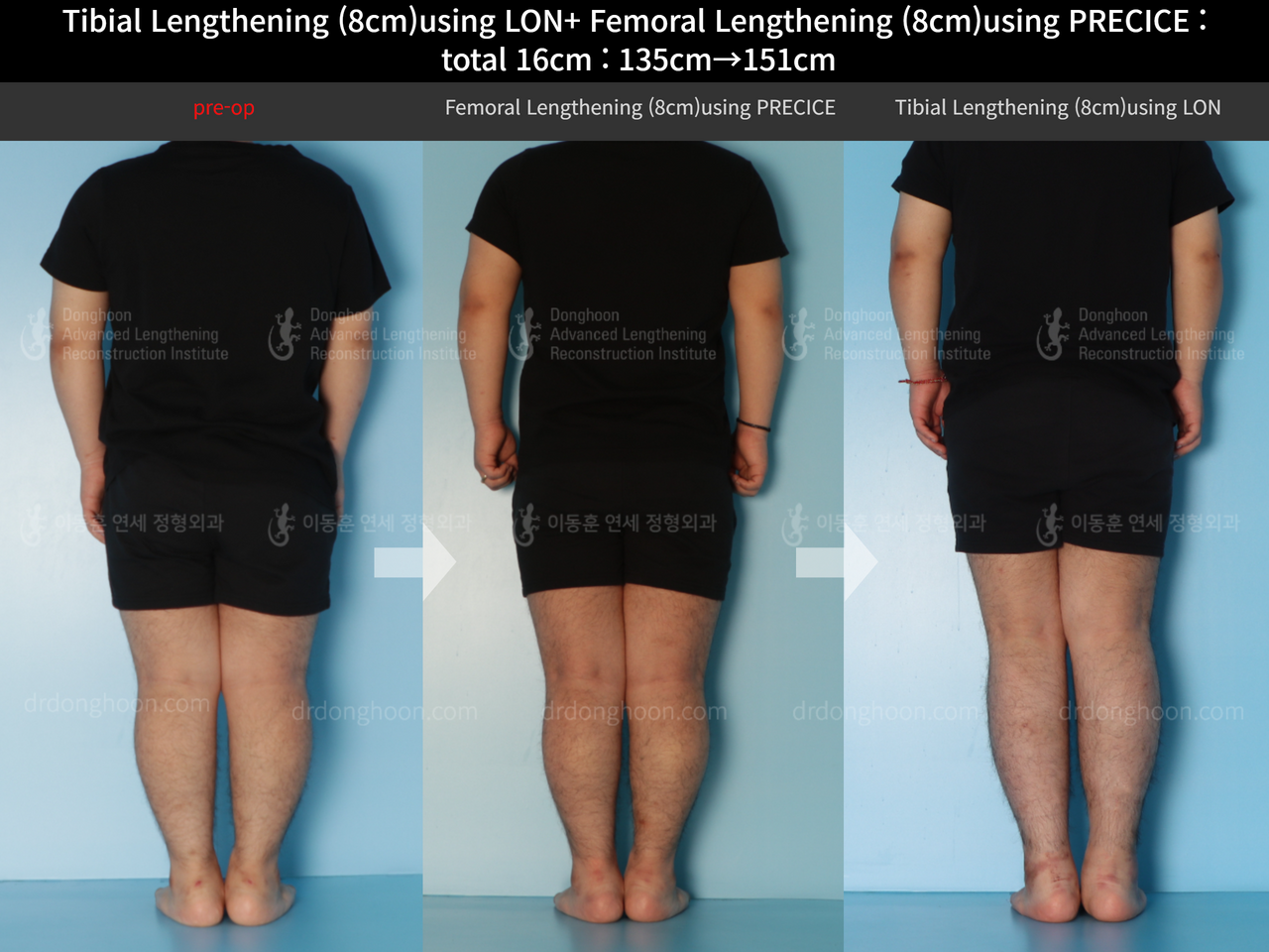 Before and after cll precice, case 12493963, image 2, Dr. Donghoon institute (DALRI)