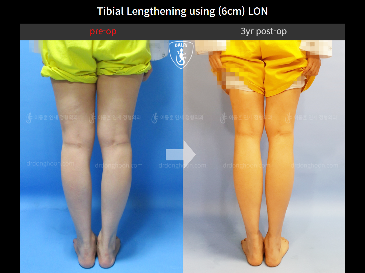 Before and after cll lon, case 4323981, image 6, Dr. Donghoon institute (DALRI)