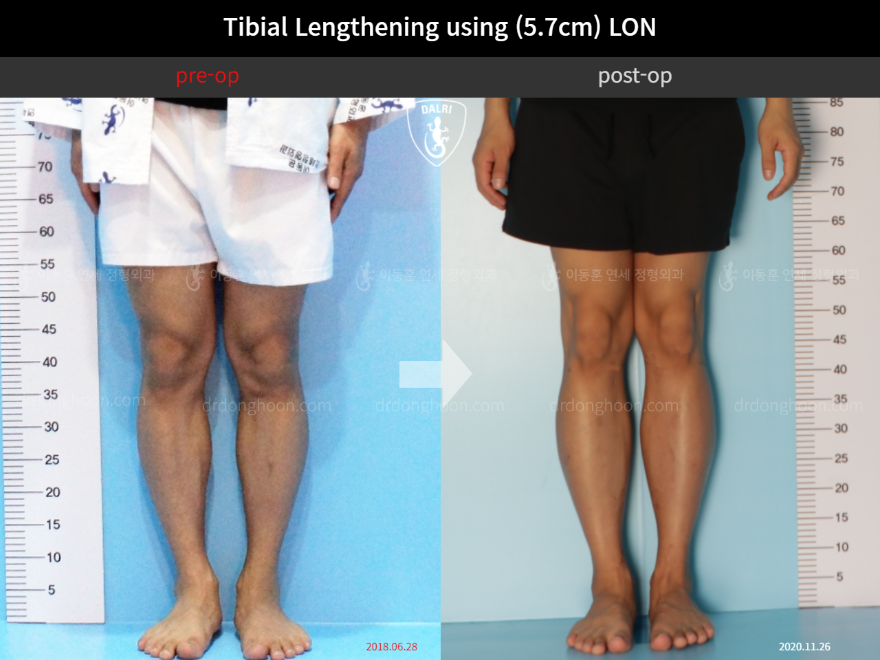 Before and after cll lon, case 4577801, image 3, Dr. Donghoon institute (DALRI)